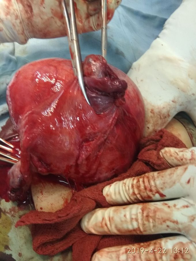 Fibroid uterus