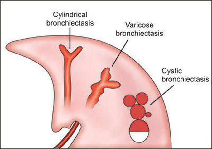 Types of bronchiectasis