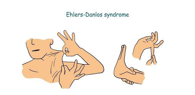 Ehler danlos syndrome symptoms