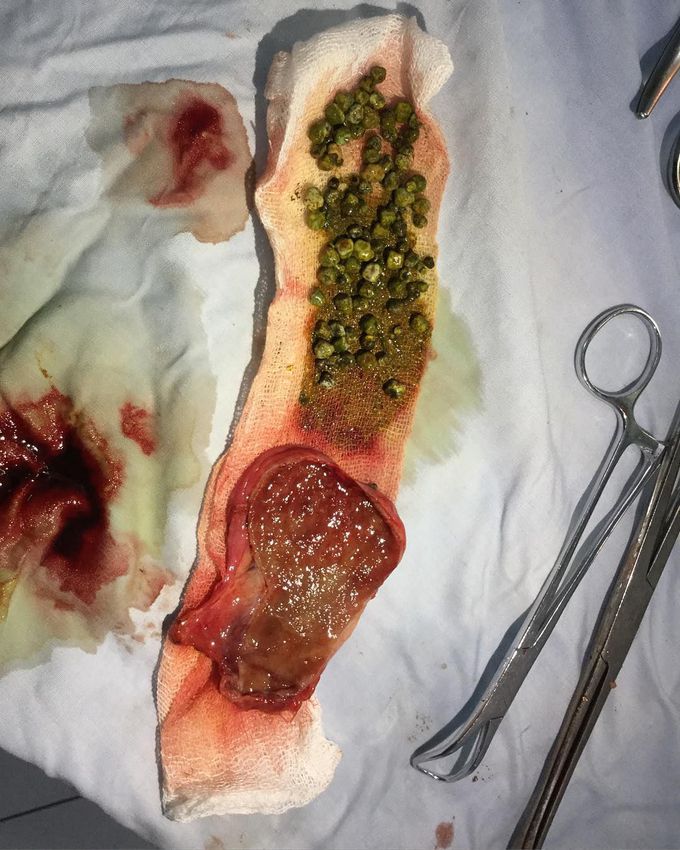 Gallbladder