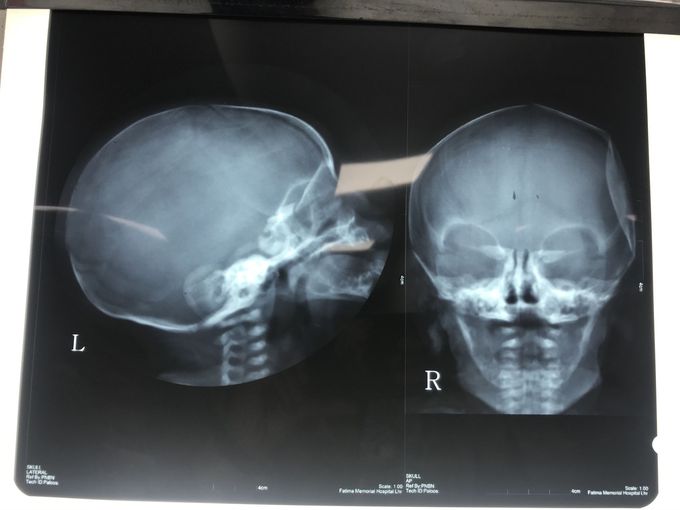 Depressed Temporal Bone