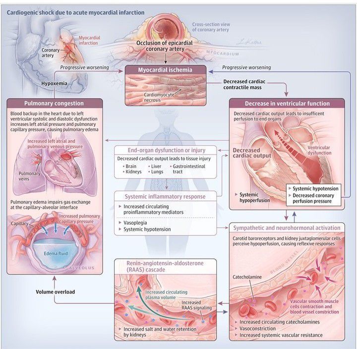 Cardiogenic Shock - MEDizzy