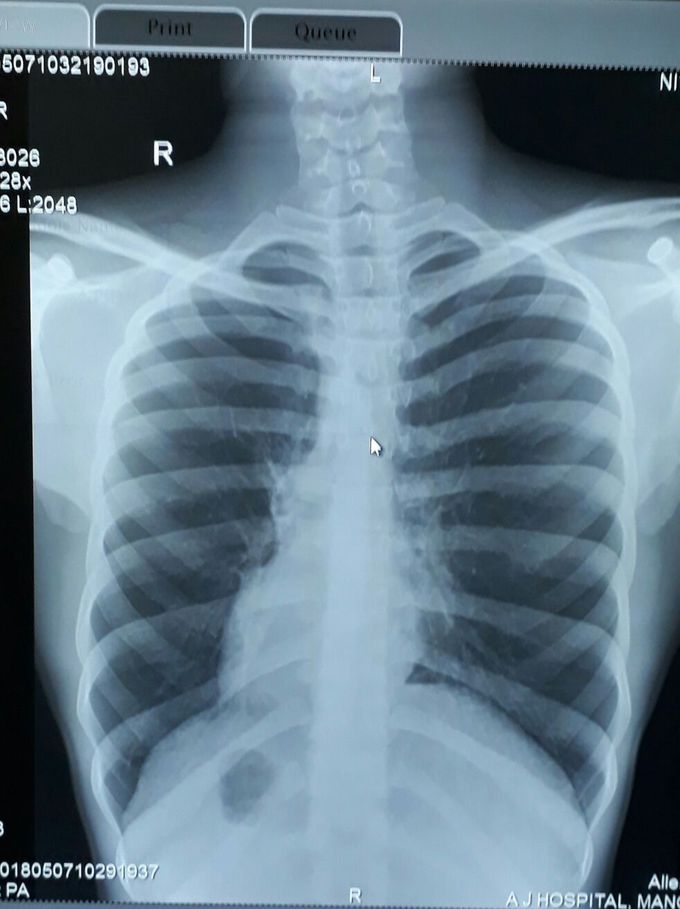 Dextrocardia with situs inversus