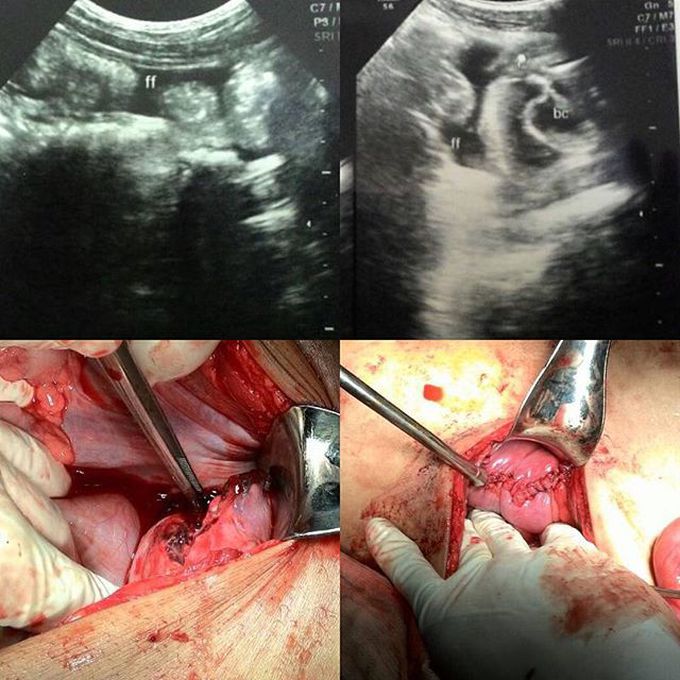 A young man with blunt injury in his lower abdomen.
