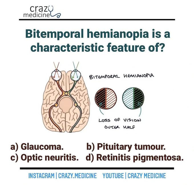 Bitemporal Hemianopia