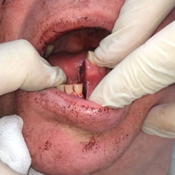 Fracture of jaw