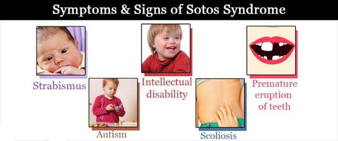 These are the symptoms and signs of Sotos syndrome