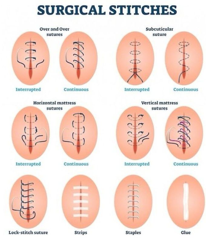 Surgical Stitches