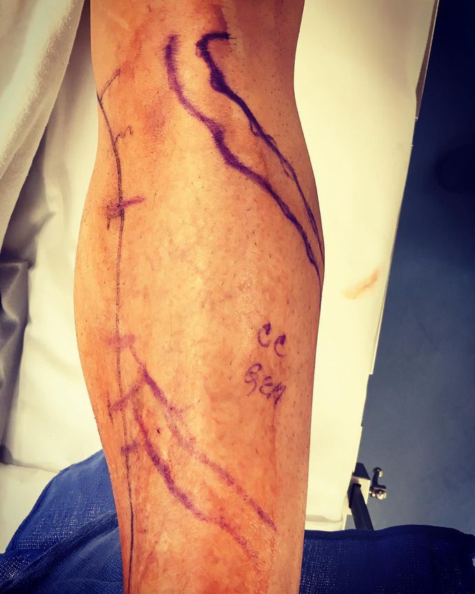 Varicose vein surgery