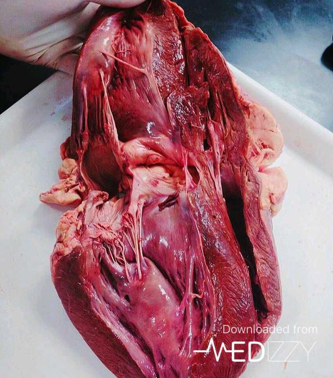 Dissected heart