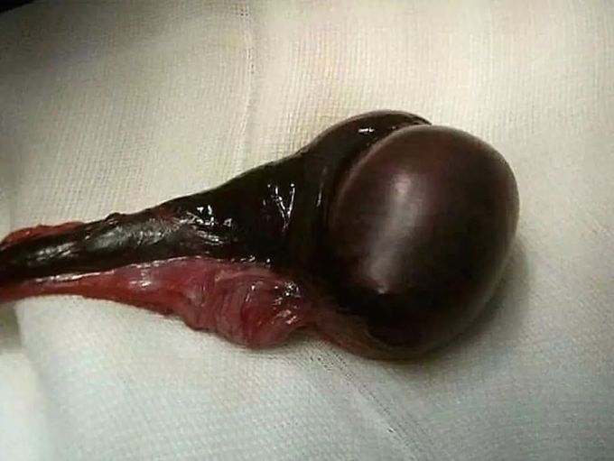 Testicular Necrosis