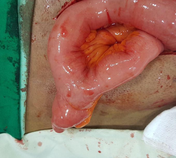 57year old being operated for .ca sigmoid showed this blind pouch.