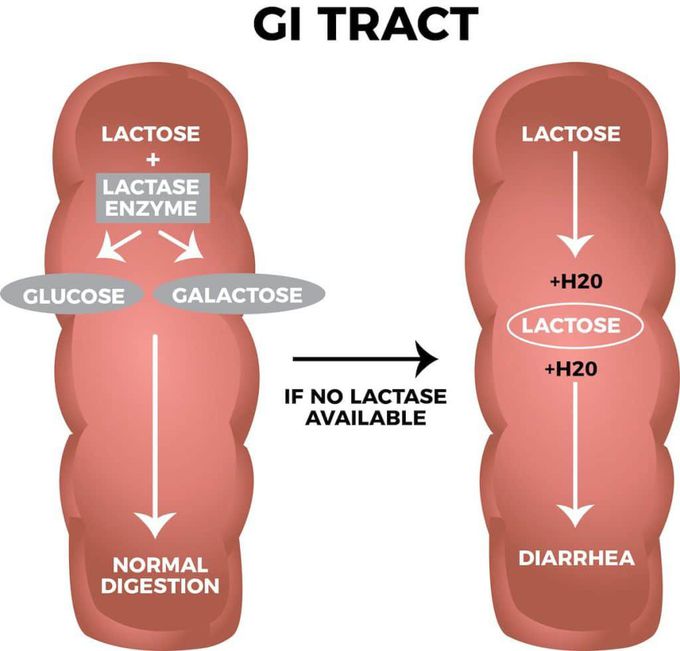 Lactose Intolerence