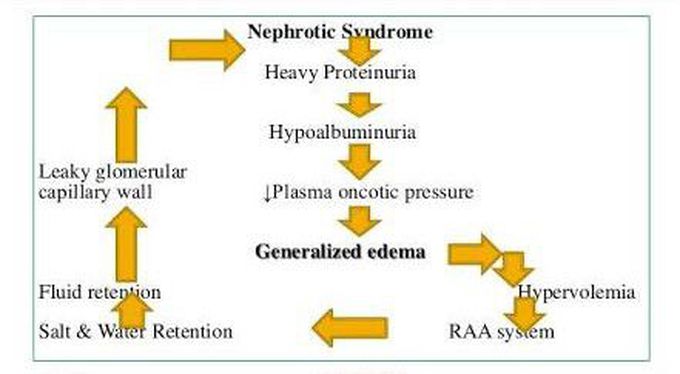 Nephrotic Syndrome