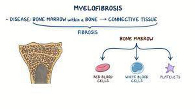 How is myelofibrosis treated?