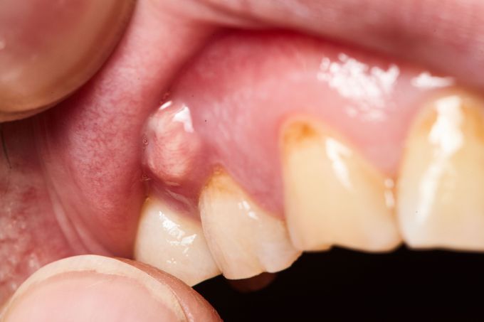 Indications of incision and drainage in mouth