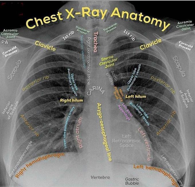 Chest X-ray