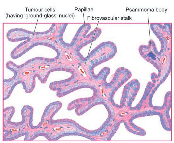 Papillary carcinoma thyroid