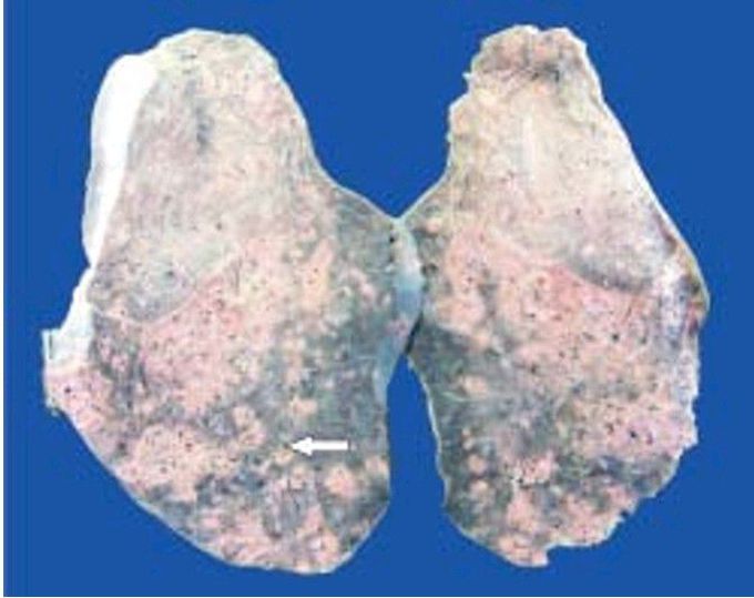 Miliary tuberculosis lung