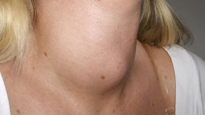 What will be the treatment for goiter?