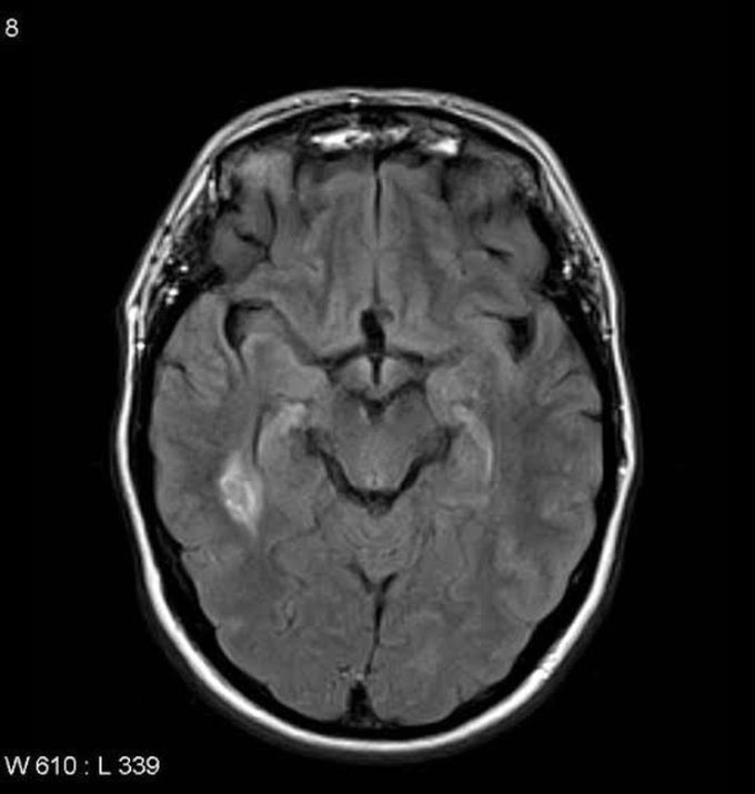 Causes of neurosarcoidosis