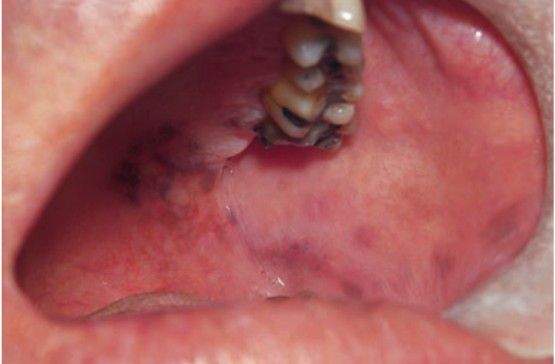 melanotic macule icd 10 Melanocytic Lesions | A Guide to Clinical Differential Diagnosis of Oral  Mucosal Lesions | Continuing Education Course