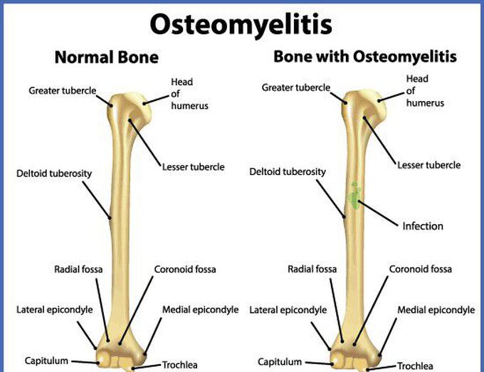 Normal bones vs bone with osteomyelitis