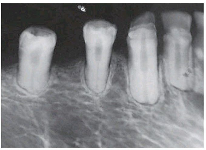 Dental anomalies in hypoparathyroidism