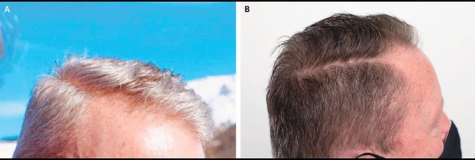 Hair Repigmentation Induced by Nilotinib