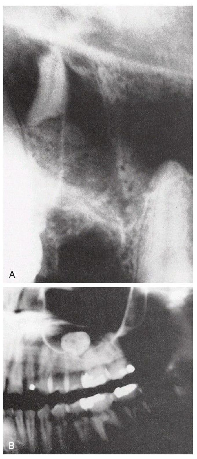 Root displacement