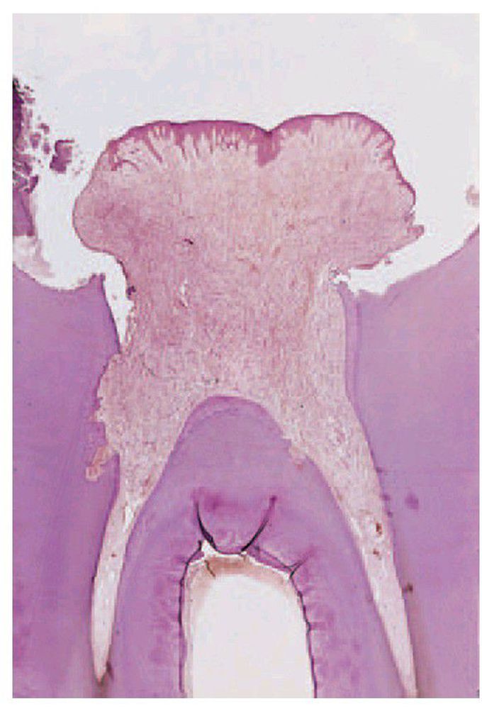 Pulp polyp.