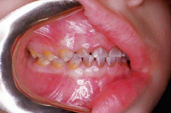 Tetracycline staining