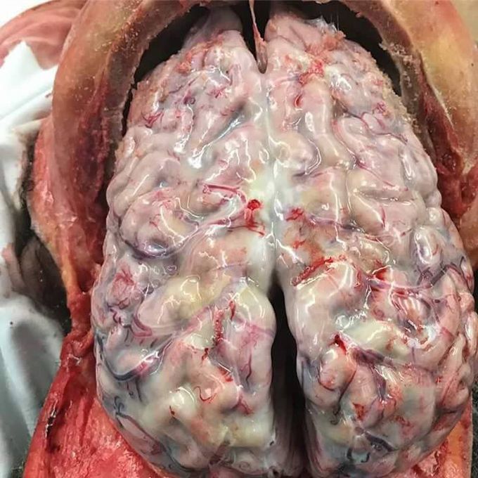 Bacterial meningitis