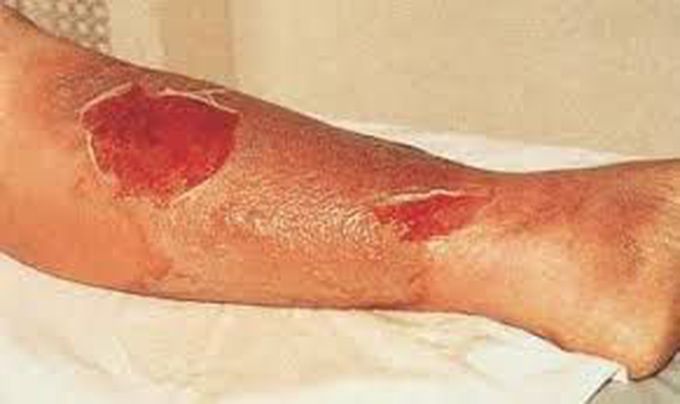 Symptoms of cellulitis