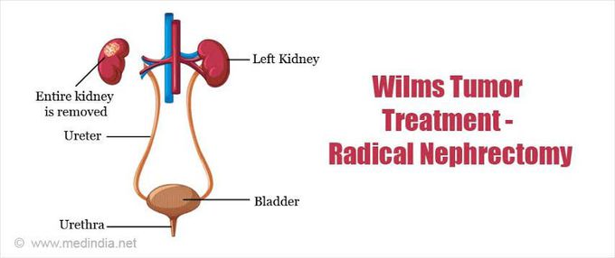 Treatment of wilms tumor