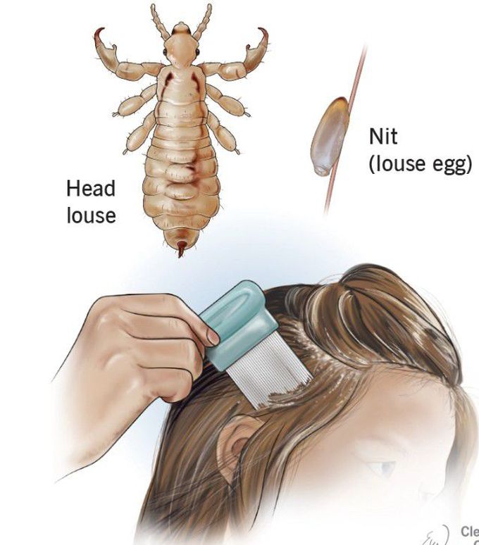 Head lice and nits