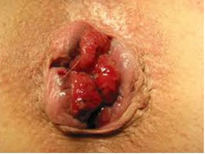 Hemorrhoids
