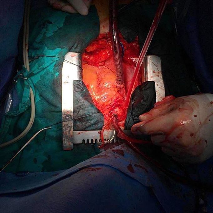 On-pump coronary artery bypass graft!  