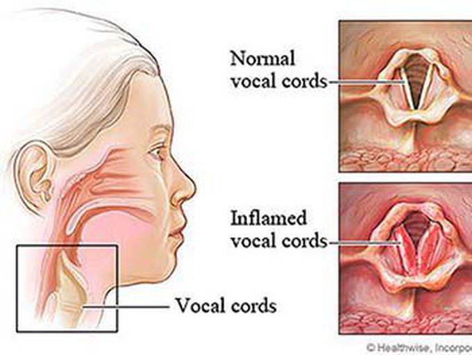 Laryngitis