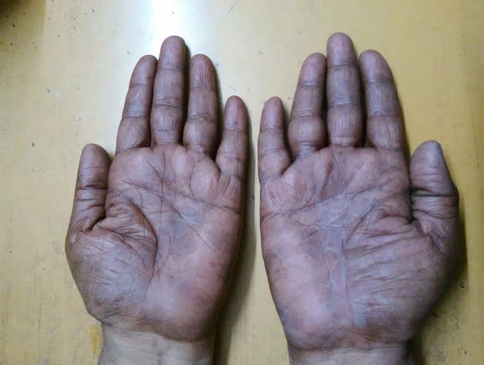 Guess the disease