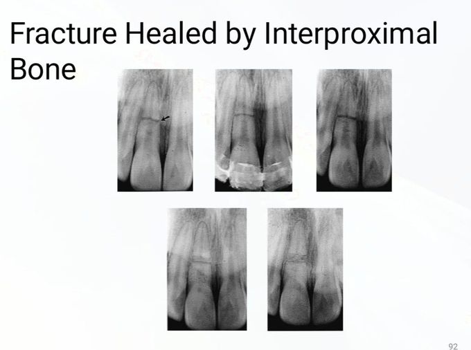 Healed Fracture