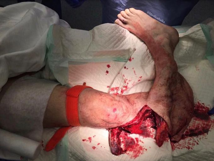 Severely injured leg!  