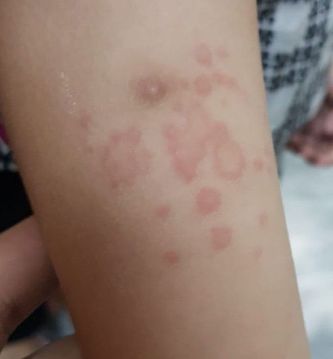 Tinea corporis - MEDizzy