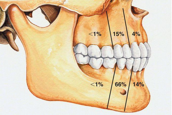 Lateral Periodontal Cyst