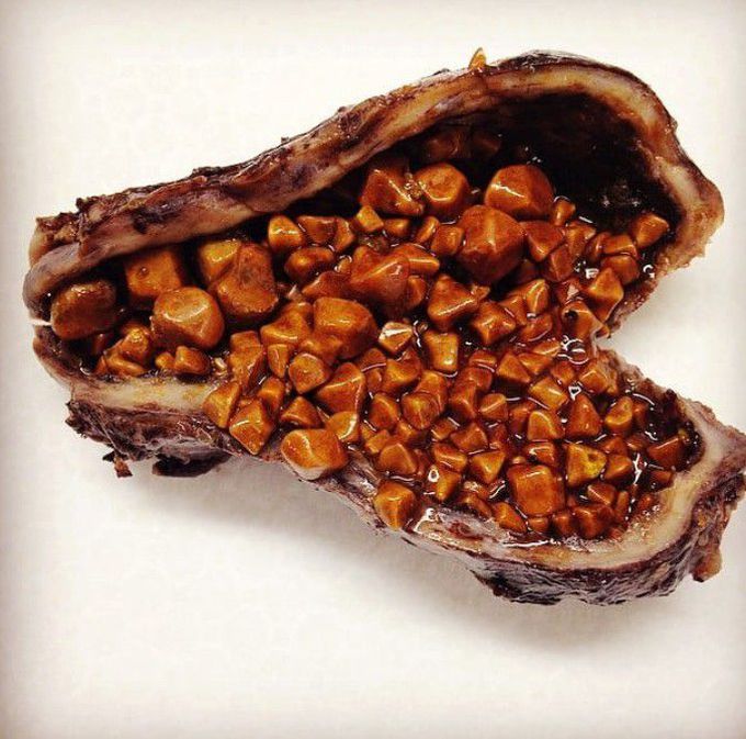 Cholesterol gallstones