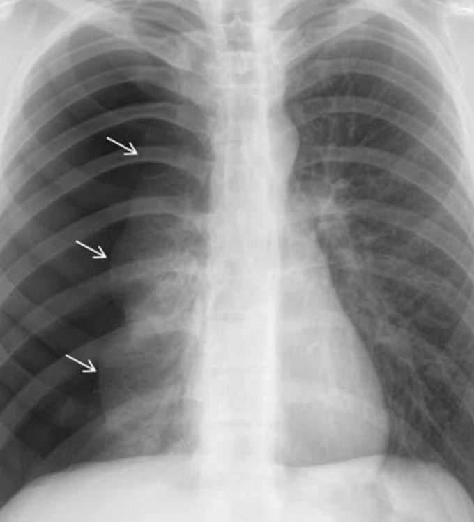 Pneumothorax??