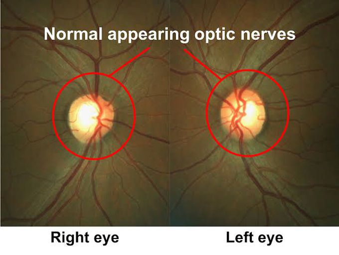 Optic Neuritis Medizzy 