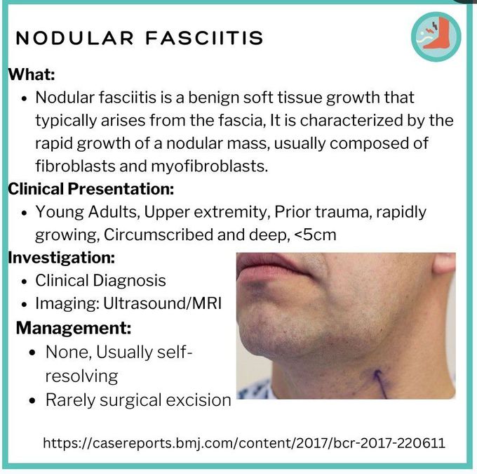 Nodular Fascitis