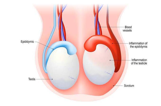 Epididymo-orchitis