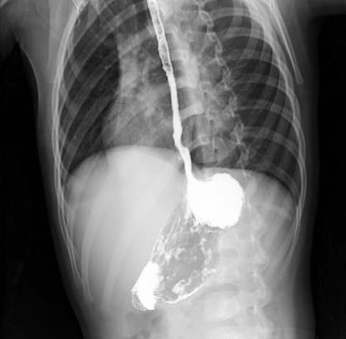 This radiography shows the result of a corrosive injury which is stricture formation